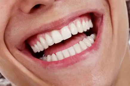 teeth-whitening-yorktown-heights
