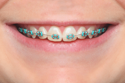 Affordable Braces Jefferson Valley, NY