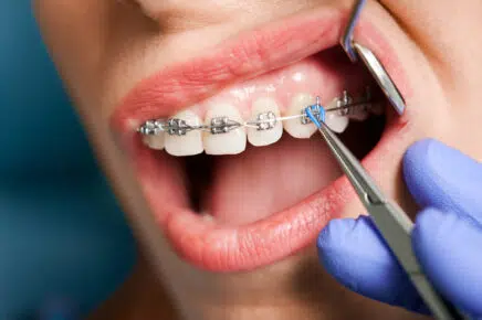 braces near me