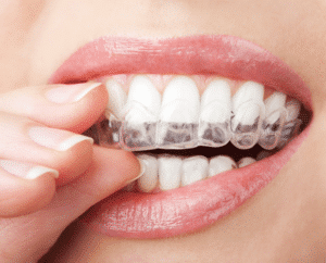 Custom-fit Dental Retainers to Keep Teeth From Shifting