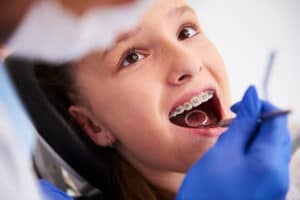 Teen Braces
