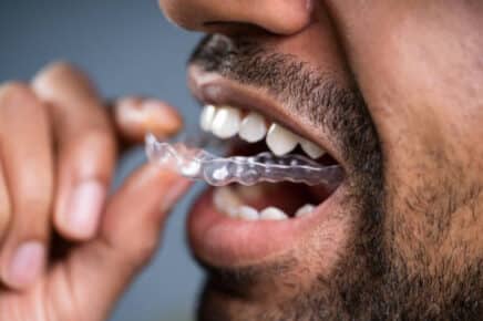 what does Invisalign do